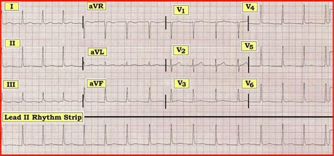nonspecific t wave abnormality|nonspecific st changes on ekg.